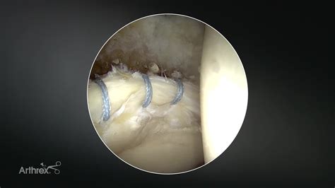 acetabular labrum repair